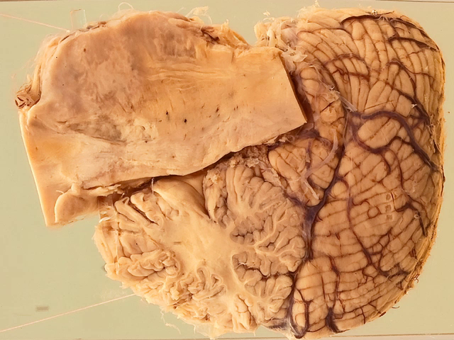 Tuberculoma (Pons)