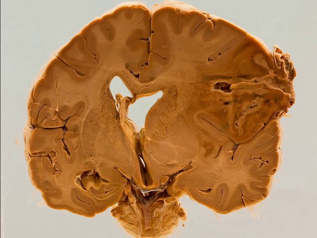 Actinomycotic cerebral abscess