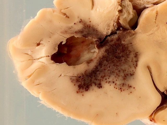 Cerebral abscess with ventriculitis