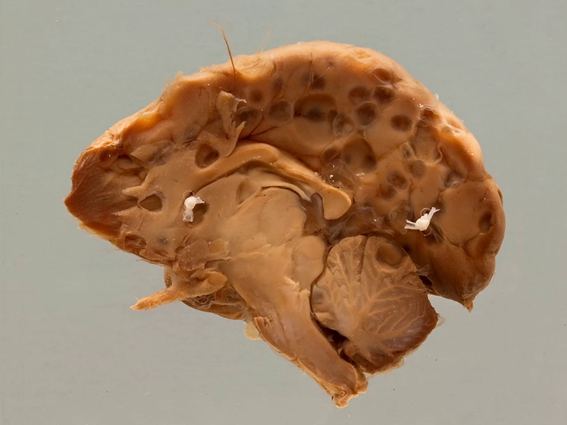 Cerebral cysticercosis