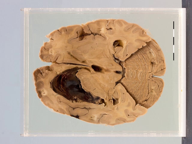 Cerebral haemorrhage