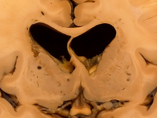 Cerebral atherosclerosis