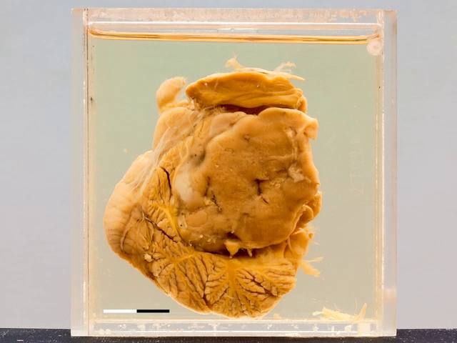 Medulloblastoma