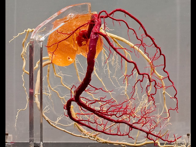 Normal coronary arteries