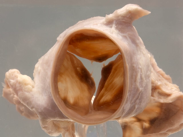 Normal heart aortic root