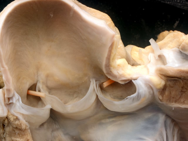 Normal heart left ventricular outflow tract