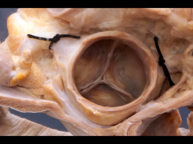 Normal aortic valve from above