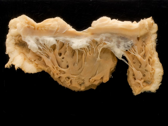 Normal Aortic Valves