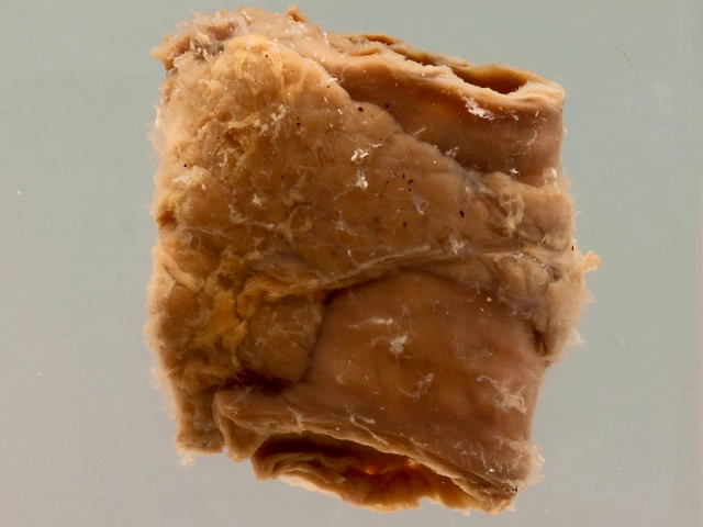 Annular pancreas