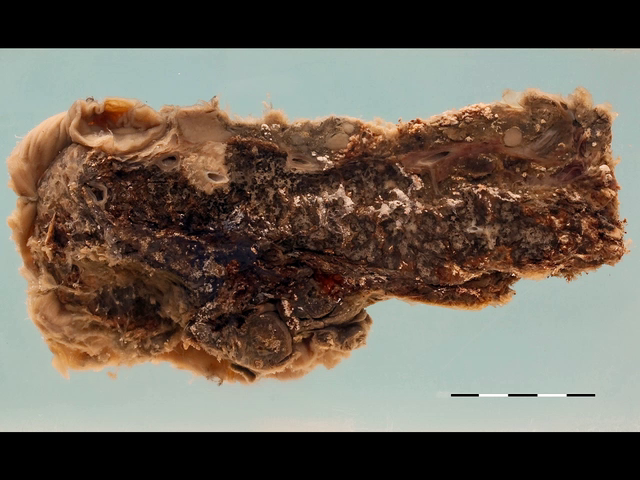 Acute haemorrhagic pancreatitis