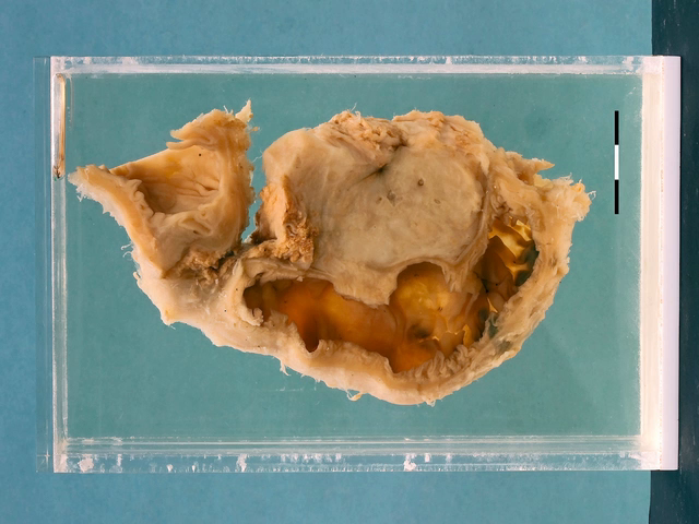 Chronic pancreatitis