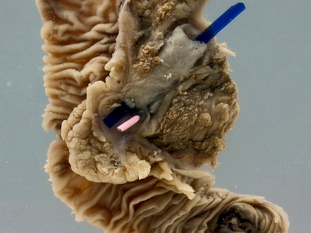 Adenocarcinoma of the ampulla of Vater