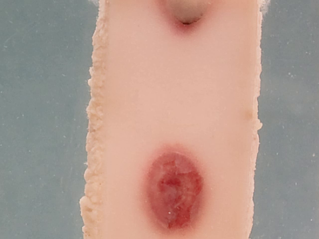 Lung and skin manifestations of pseudomonas septicaemia