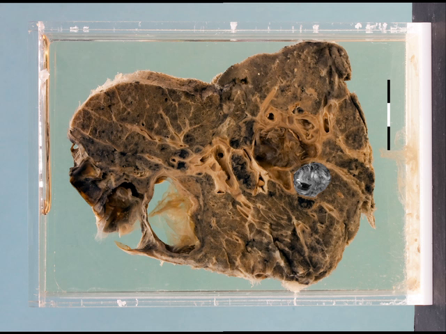 Hydatid cysts