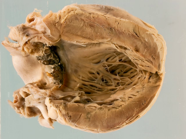 Acute bacterial endocarditis