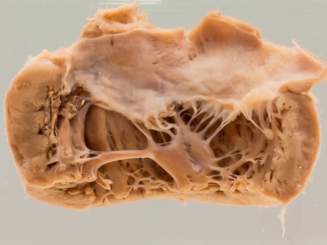 Acute rheumatic fever