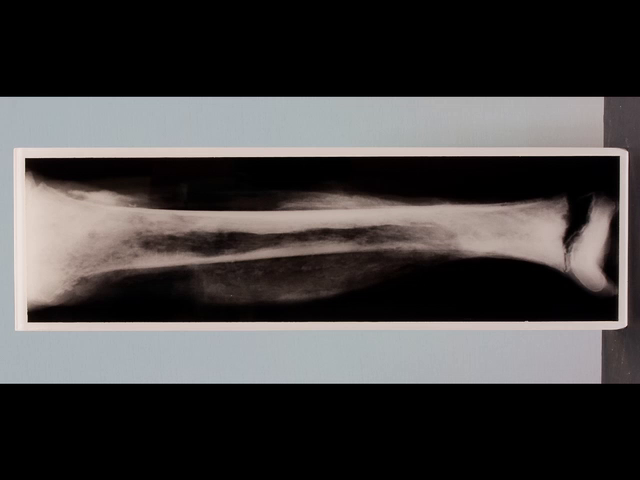 Acute staphylococcal osteomyelitis