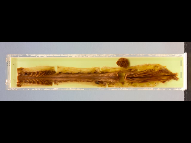 Ependymoma of the spinal cord
