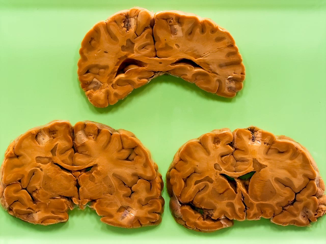 Multiple sclerosis