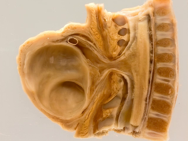 Meningocoele