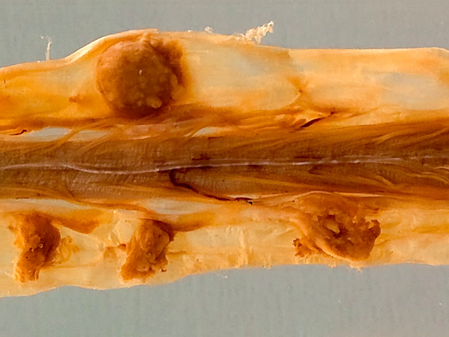Spinal meningioma