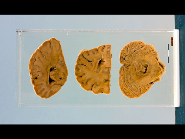 Multiple sclerosis