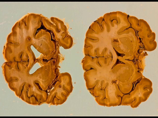 Huntington disease