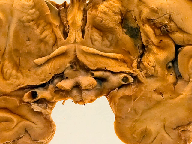 Haemorrhagic infarct of the basal ganglia