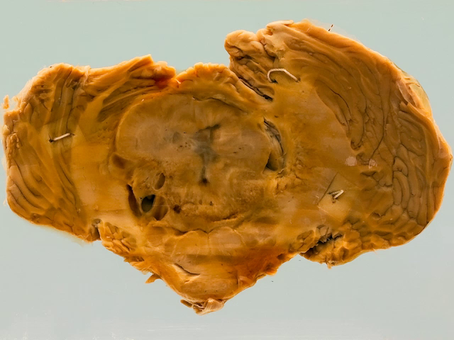 Medulloblastoma