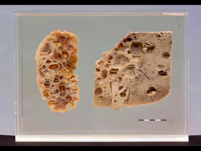 Autosomal dominant polycystic kidney disease (AD-PKD)