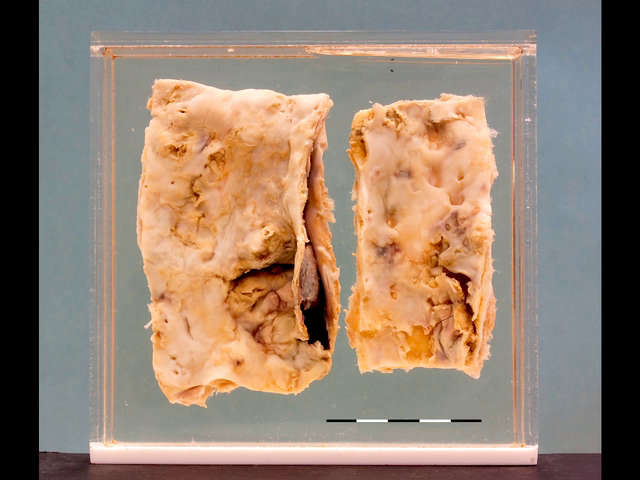Severe atheroma