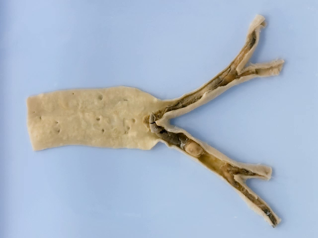 Saddle embolus at the aortic bifurcation
