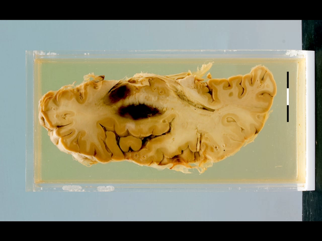 Cerebral infarct with haemorrhagic necrosis