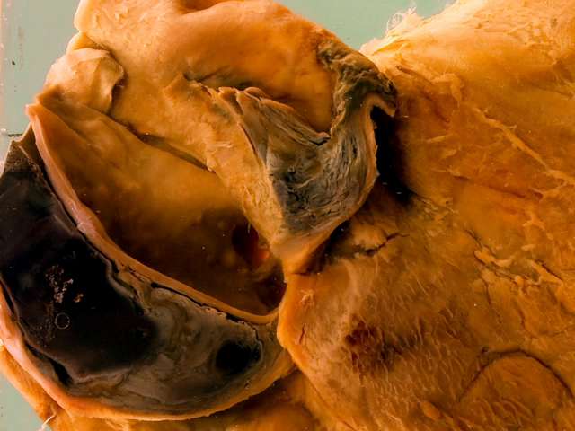 Aortic dissection in Marfan's syndrome