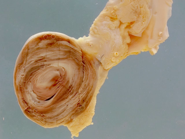 False aneurysm of the external iliac artery