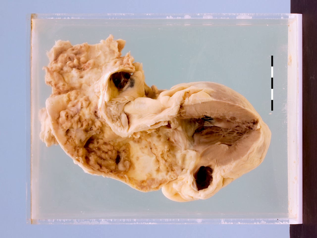 Syphilitic aortitis with atheroma