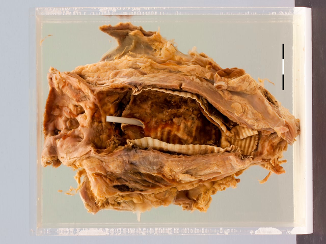 Aorto duodenal fistula