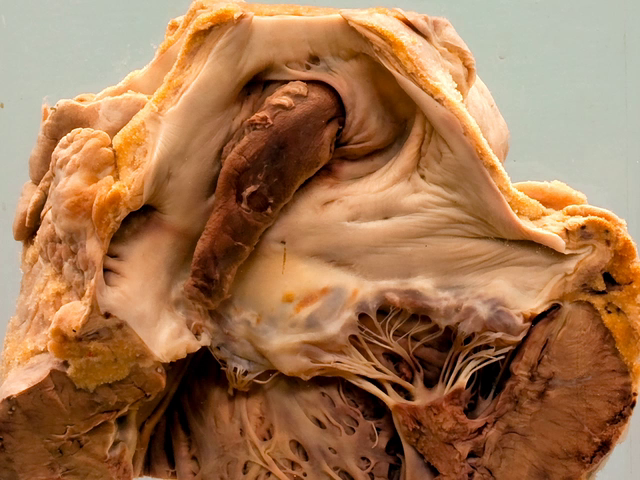 Paradoxical embolism