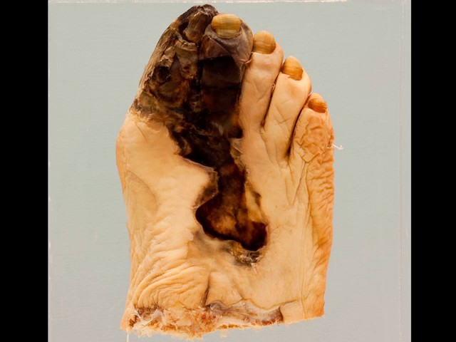 Gangrene in diabetes