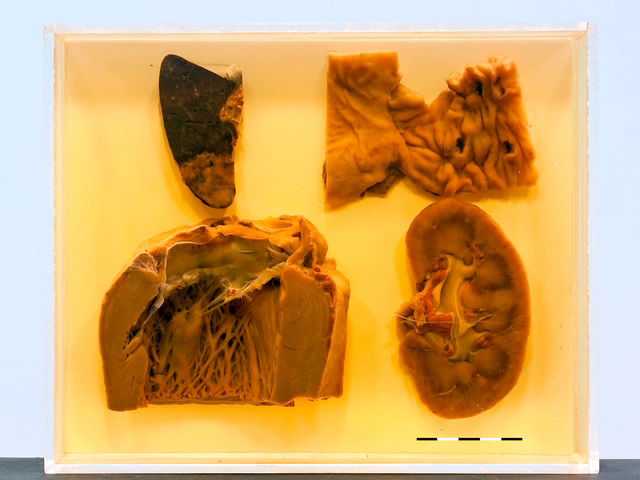 Libman-Sacks endocarditis in SLE