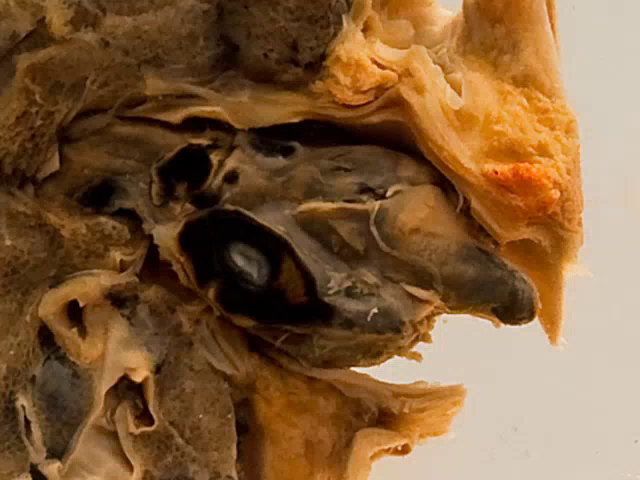 Venous thrombo-embolism