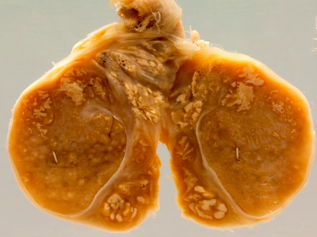Tuberculosis of the testis-epididymis