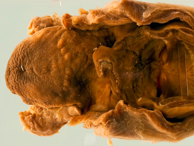 Erythema nodosum leprosum in the larynx