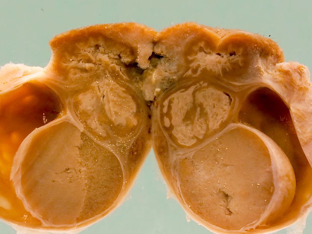 Tuberculous epididymitis