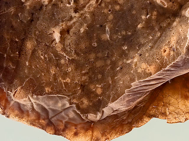 Miliary abscesses due to melioidosis