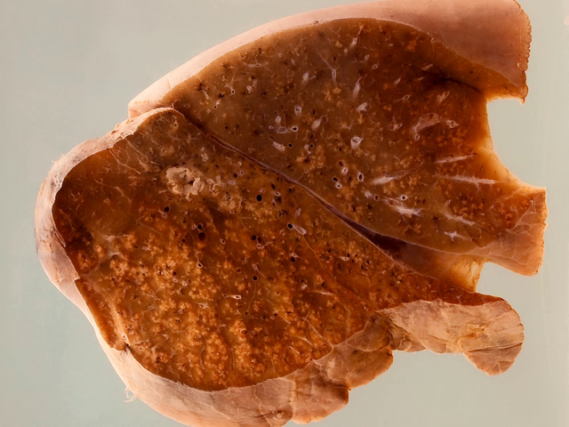 Lung showing miliary tuberculosis