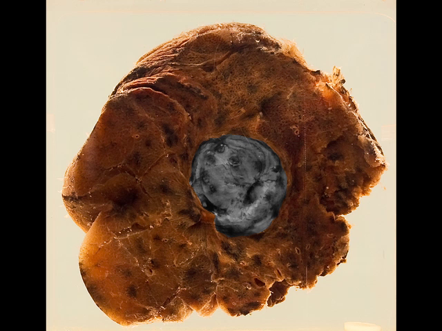 Tuberculoma of the lung