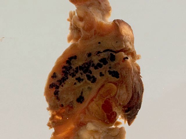 Mycetoma