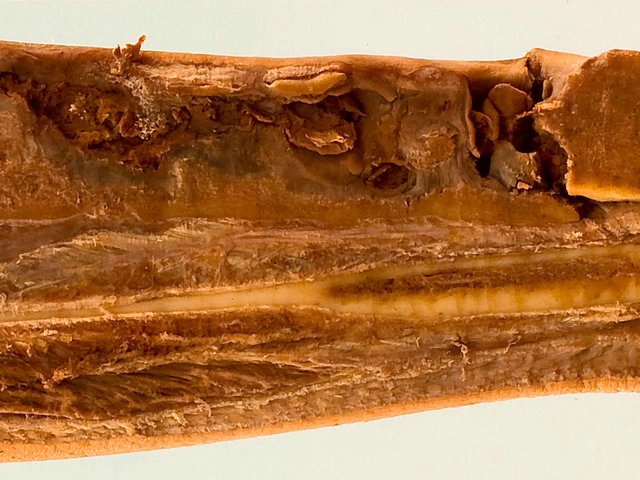 Chronic osteomyelitis of the tibia