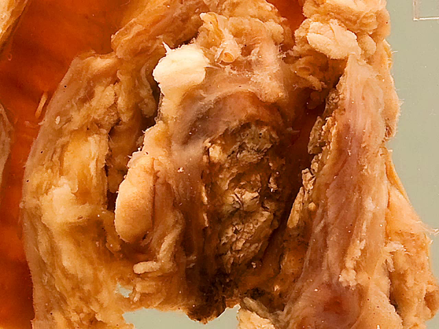 Carinal lymph node (tuberculosis)